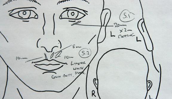An medical drawing of the face and head used to record scars for a medico-legal report